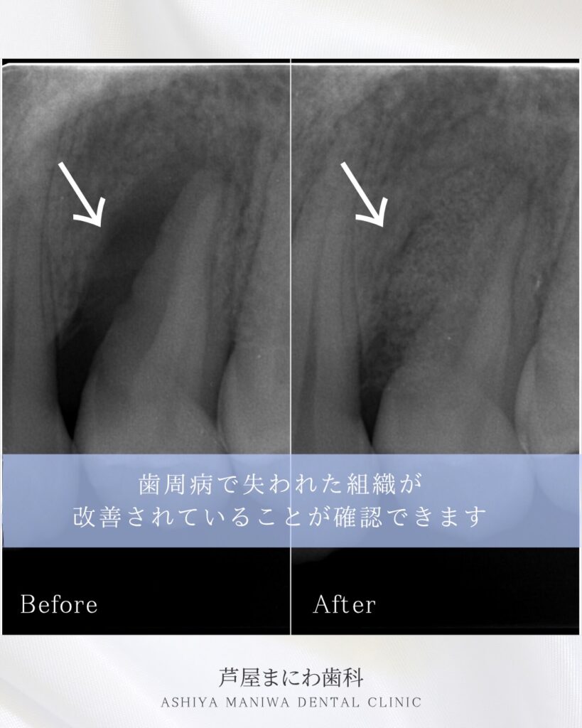 ■ レントゲン画像から見る治療前後の変化
